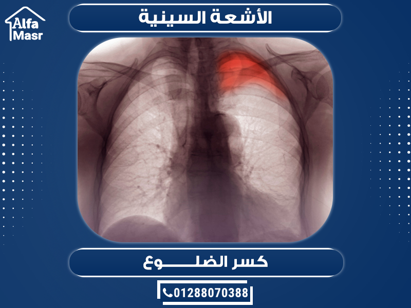 الأشعة السينية X-Ray كسر الضلوع
